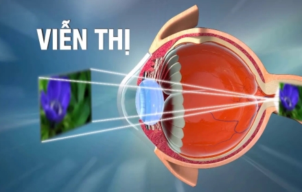Điều trị tật viễn thị